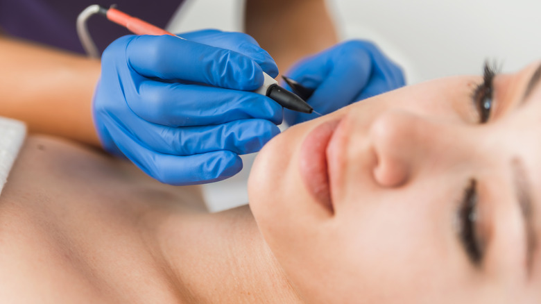 Woman having electrolysis done on her face by person wearing surgical gloves and holding electrolysis needle