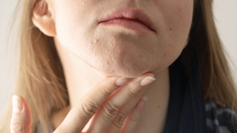 acne prone skin 