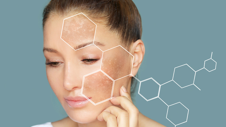 Woman with hyperpigmentation and graphic of chemical compound