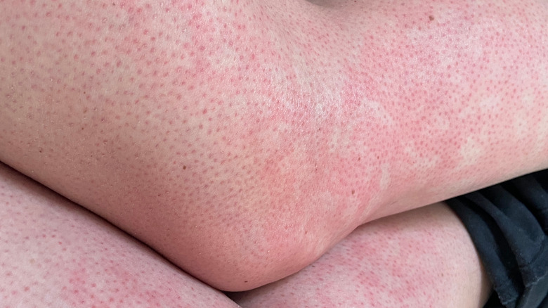 Toasted skin syndrome